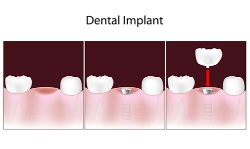 Carey dental implants