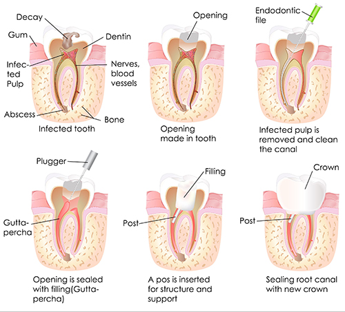 root canal 79201